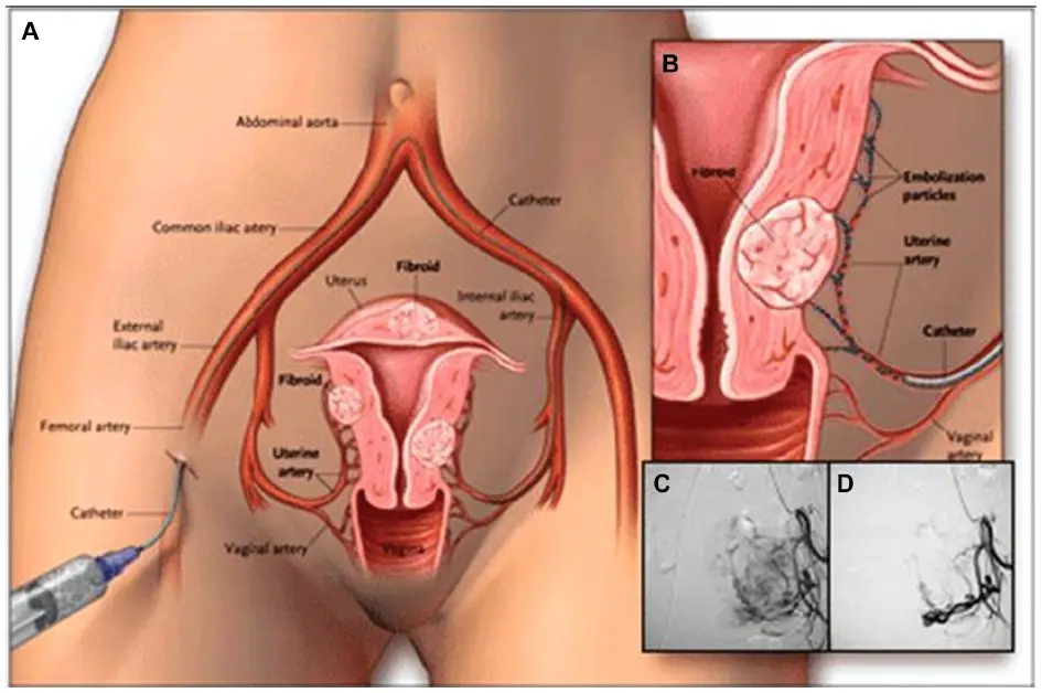 Removal of fibroids during pregnancy: how pregnancy proceeds after removal of fibroids