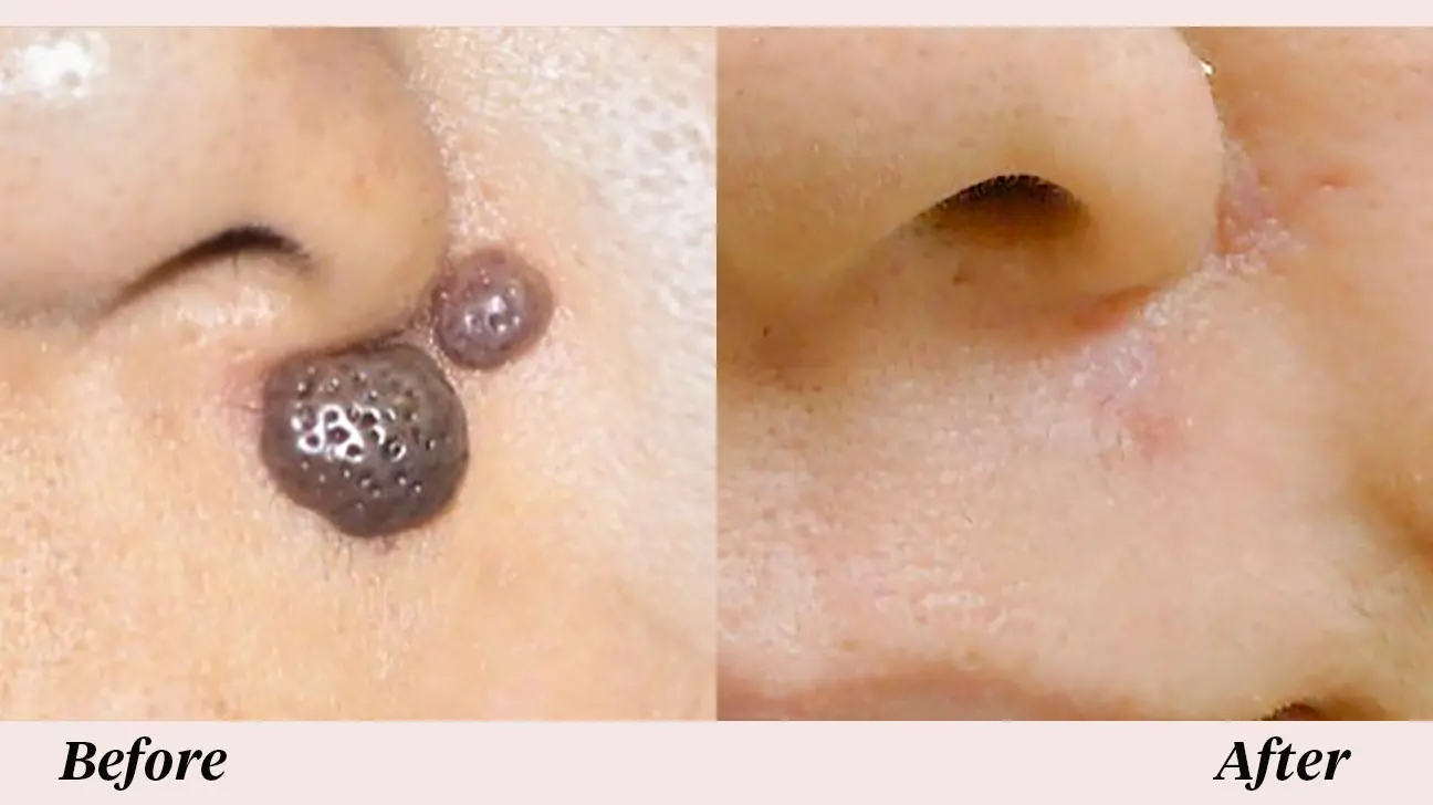 removal of moles