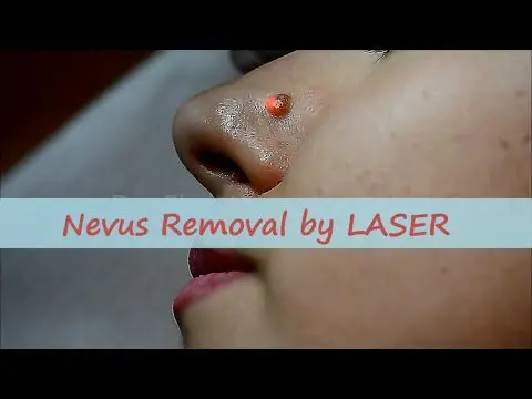 Removing a nevus: how to remove a mole?