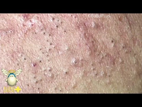 Removing acne from the forehead: video