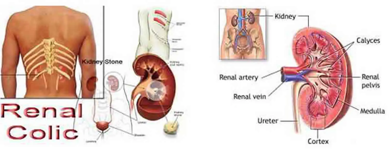 Renal colic