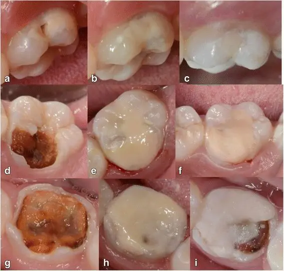 restorative procedures after the summer period