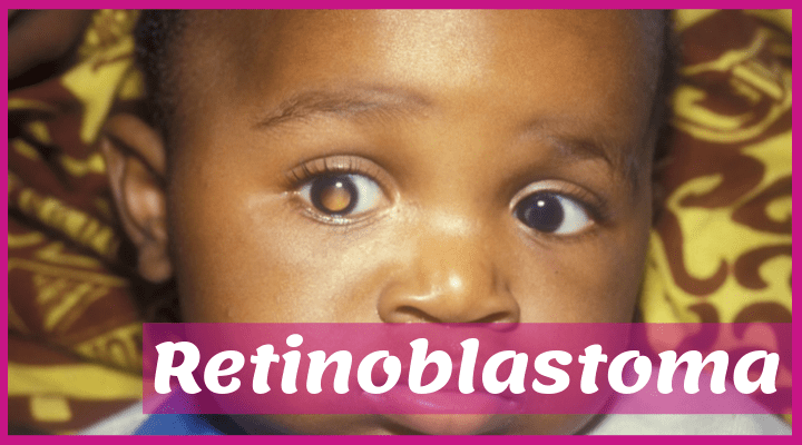 Retinoblastoma: all you need to know about this eye disease in children