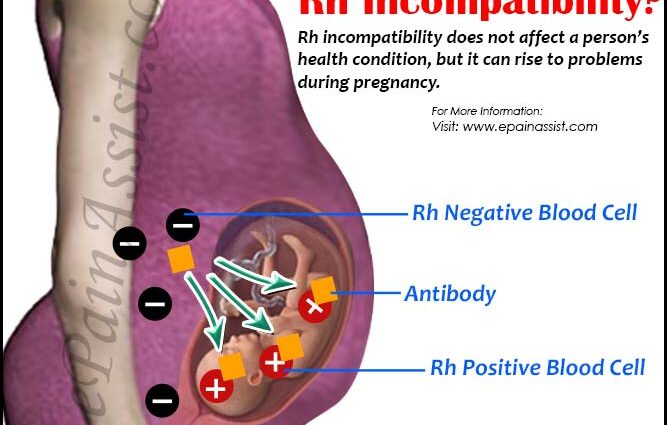 Rh-conflict during pregnancy: how to diagnose and treat