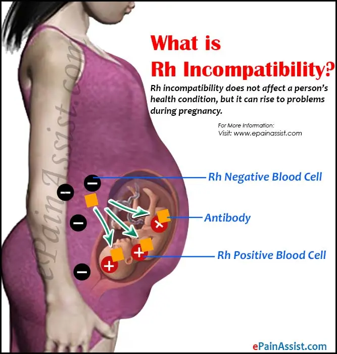 Rh-conflict during pregnancy: how to diagnose and treat