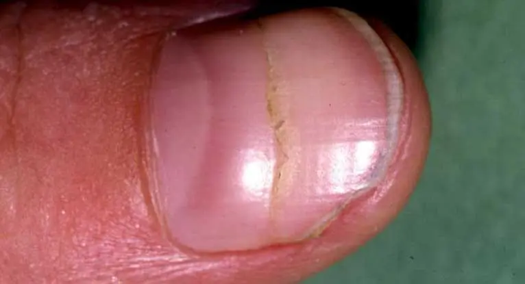 Ribs on the nails: causes and elimination. Video