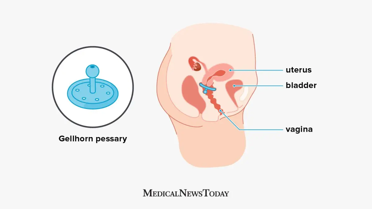 Ring or cube pessary: ​​definition and use