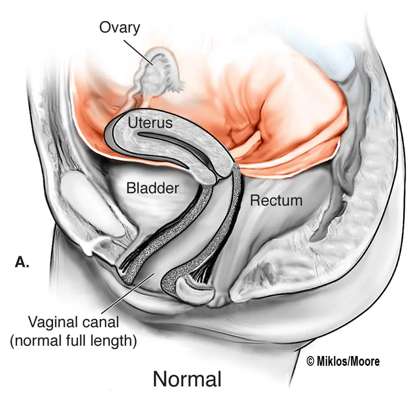 Rokitansky: all about Mayer Rokitansky syndrome