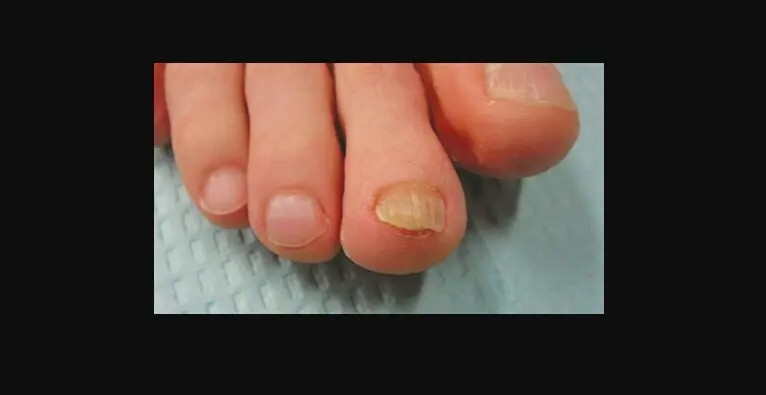 Running nail fungus, treatment and doctor&#8217;s advice