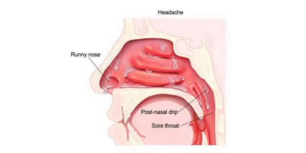 Runny nose: is it a cold or an allergy?