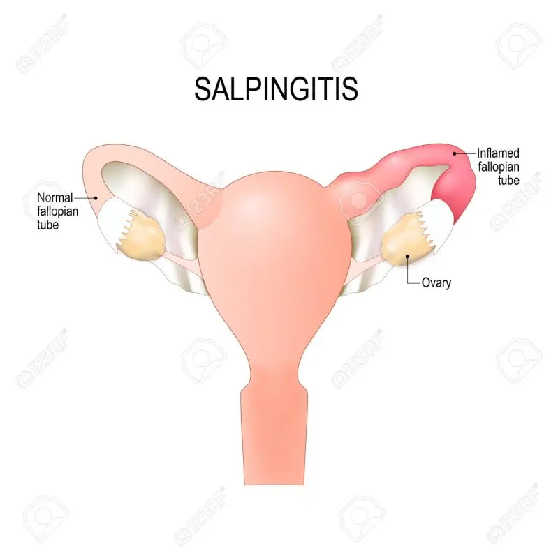 Salpingitis: inflammation of the fallopian tubes