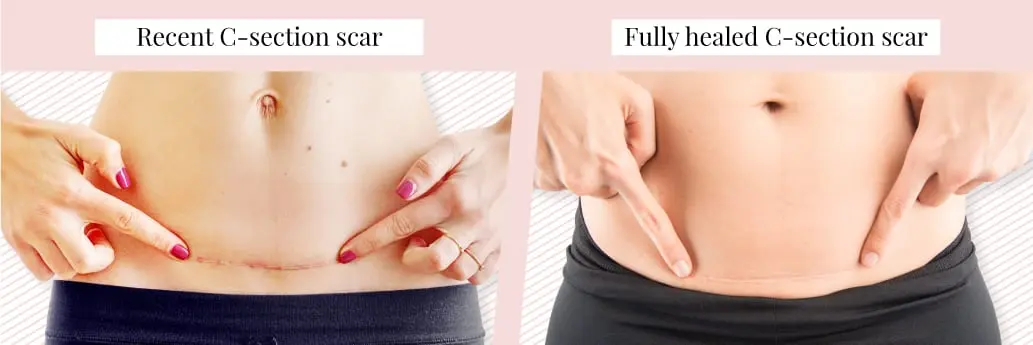 Scar after cesarean: how to remove and restore the beauty of the body. Video