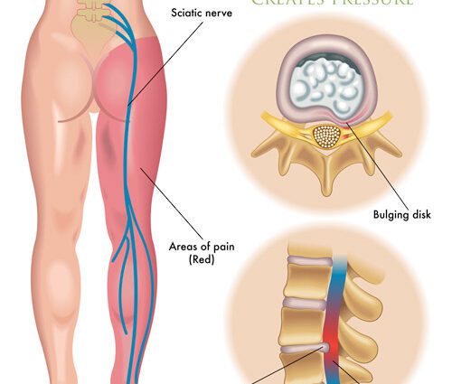 Sciatic nerve hurts during pregnancy