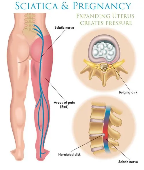 Sciatic nerve hurts during pregnancy