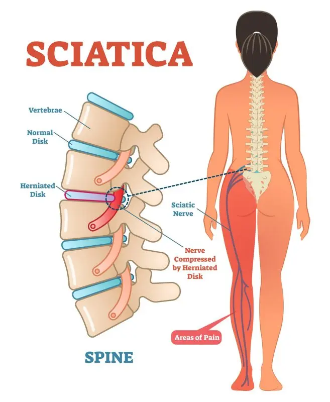 Sciatica (Neuralgia) &#8211; Sites of Interest