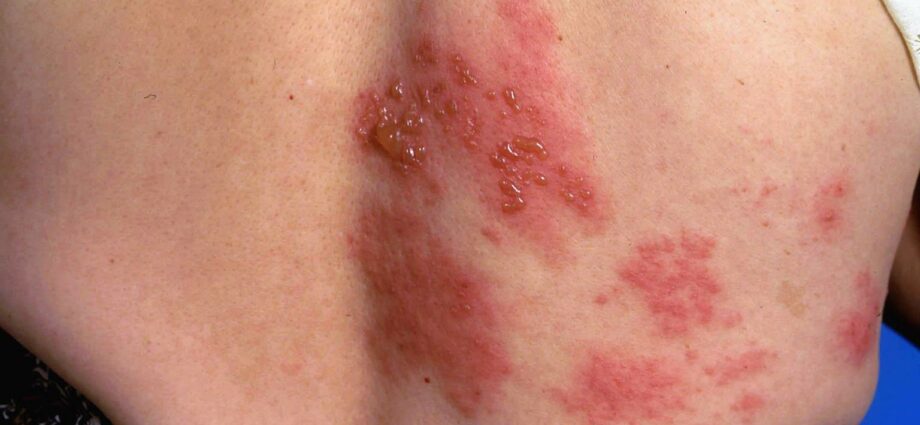 Shingles &#8211; Our doctor&#8217;s opinion and complementary approaches
