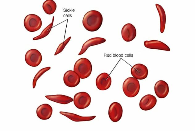 Anemia das células falciformes