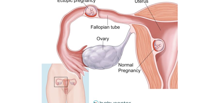 ექტოპიური ორსულობის ნიშნები, ადრეული ექტოპიური ორსულობა