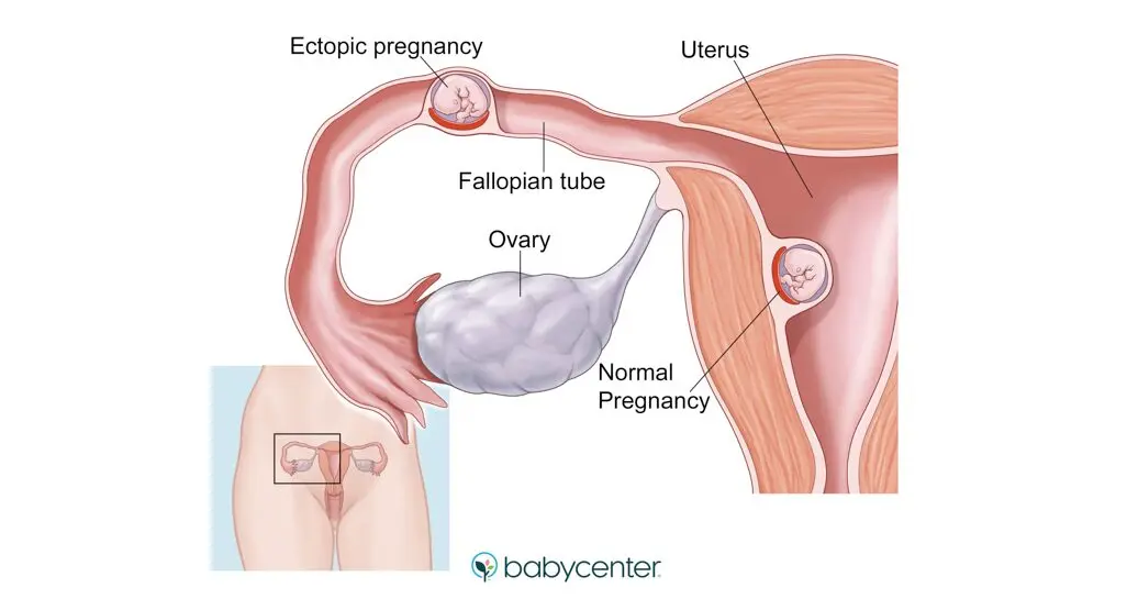 Signs of ectopic pregnancy, early ectopic pregnancy