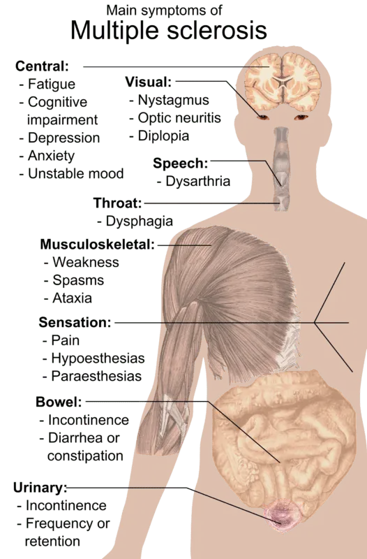 Signs of multiple sclerosis