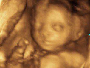 Single entanglement of the fetus with the umbilical cord: a week of pregnancy, how dangerous