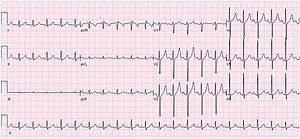 Sinus tachycardia of the heart: what is it, what is dangerous in a child