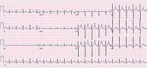 Sinus tachycardia of the heart: what is it, what is dangerous in a child