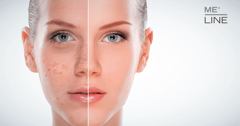 Skin hyperpigmentation is not a problem