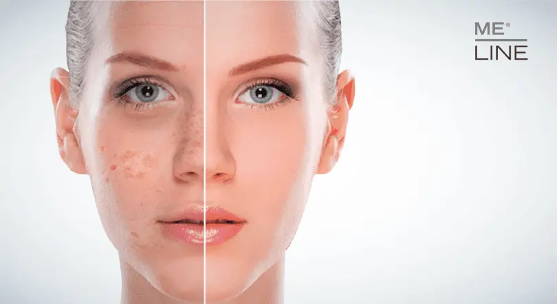 Skin hyperpigmentation is not a problem