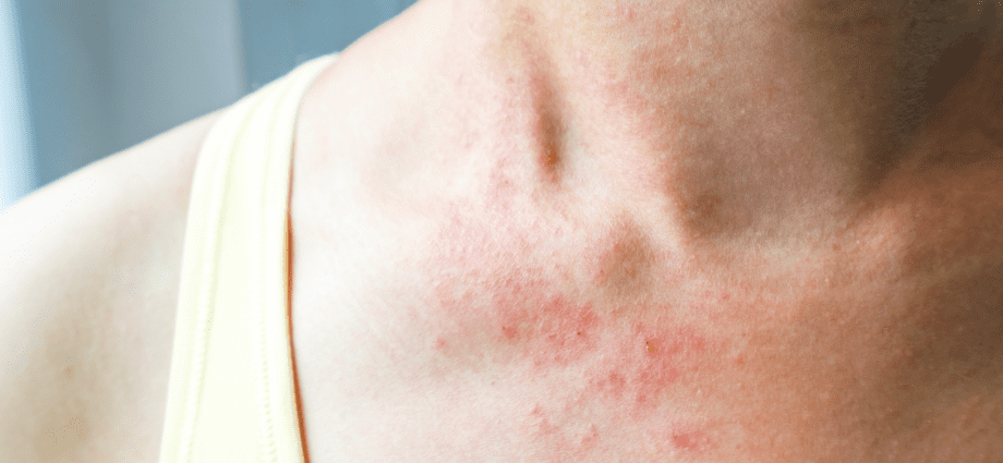 Skin rash: causes and symptoms