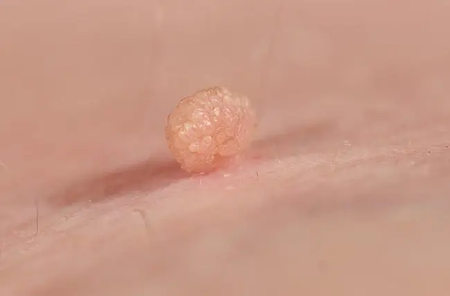 Skin tags: how to get them removed?
