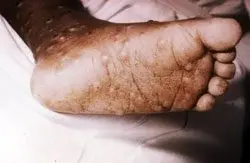 Smallpox, what is it?