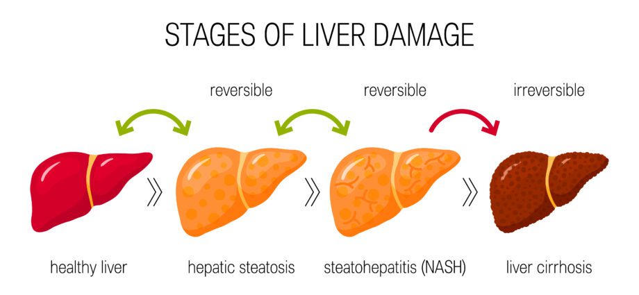 Soda (fatty liver) disease: what are the symptoms of NASH?