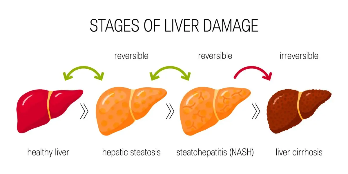 Soda (fatty liver) disease: what are the symptoms of NASH?