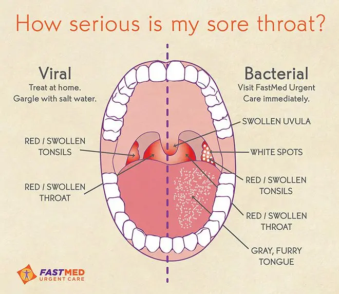 Sore throat &#8211; Places of interest