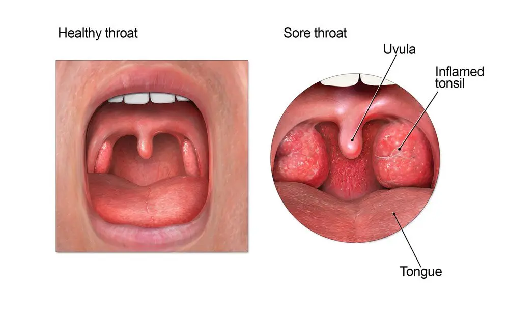 What to do when your throat hurts: expert advice