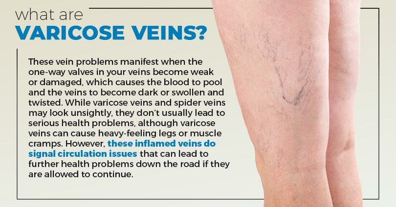 Spider veins: causes and treatments