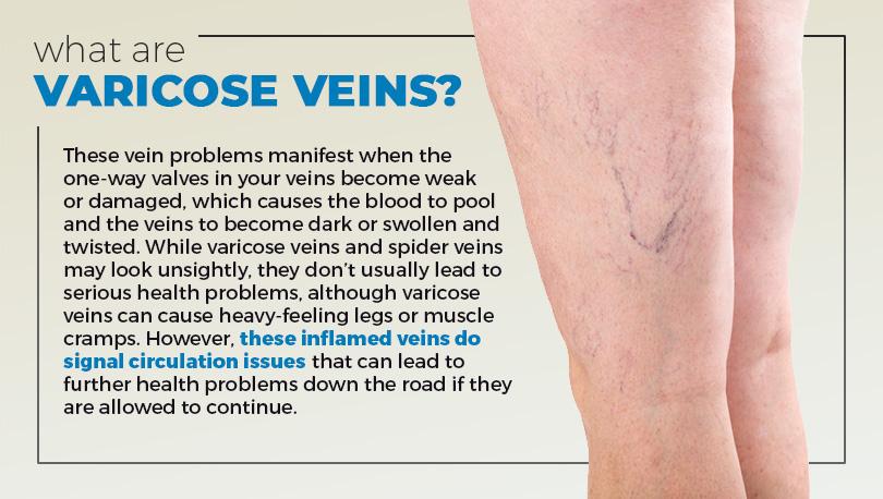 Spider veins: causes and treatments - Healthy Food Near Me