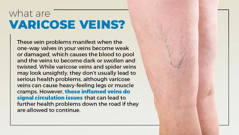 Spider veins: causes and treatments