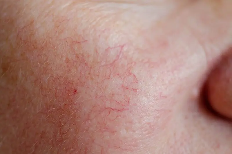 Spider veins on the face: how to remove? Video