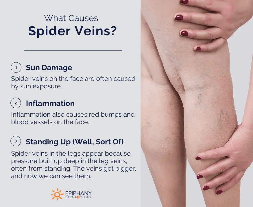 Spider veins on the legs: how to remove? Video