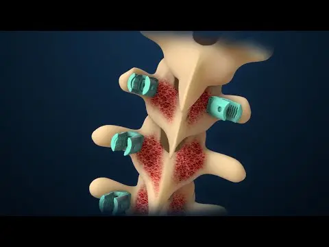 Spinal scoliosis treatment. Video