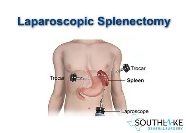 Splenectomy