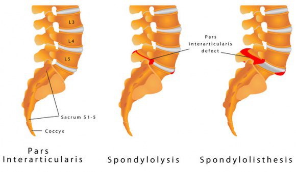 Spondylolistesis