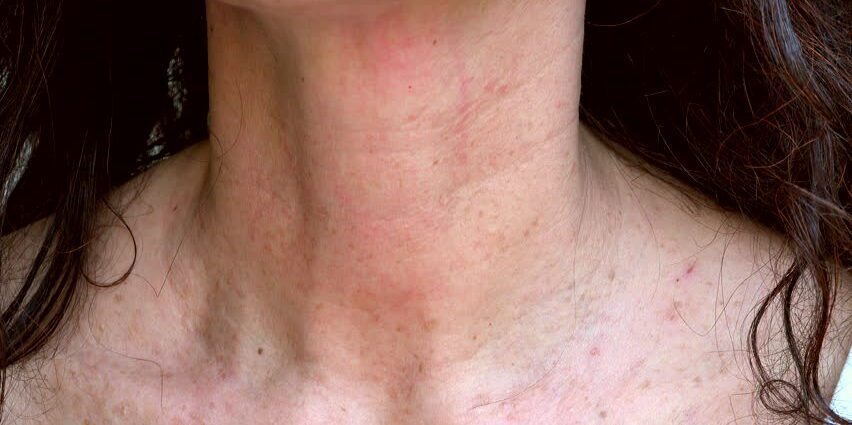 Spots on the neck: reasons. Video