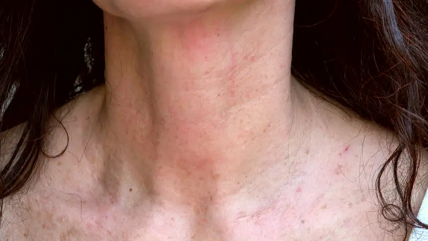 Spots on the neck: reasons. Video