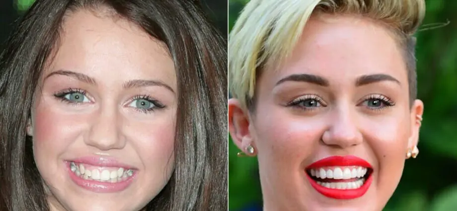 Stars who are grateful to veneers for a Hollywood smile