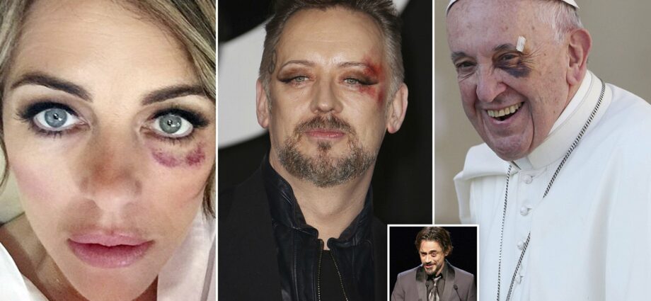 Stars who walk with bruises: photo