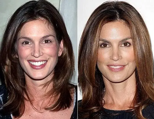 Stars with fillers before and after photos