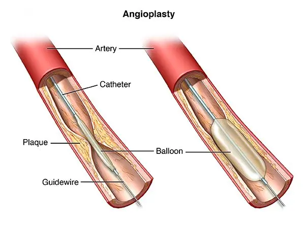 Stent placement